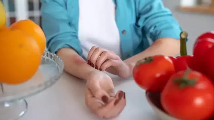 Alerjik Durumlar / Hastalıklar Nedir? Alerjik Durumlar / Hastalıklar Nedir?