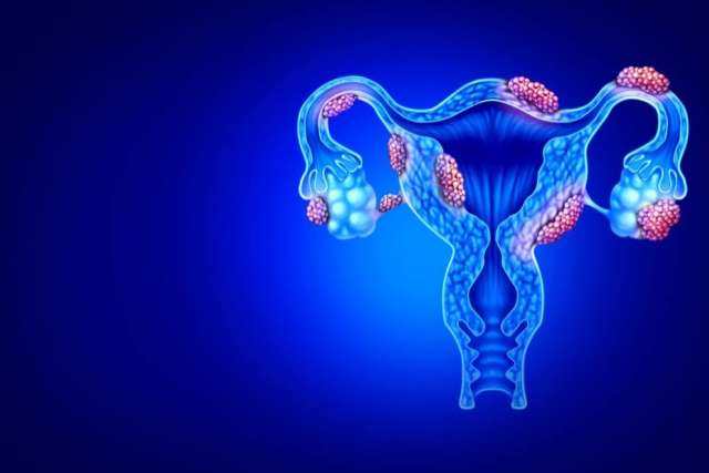 Endometriozis Nedir? Endometriozis Nedir?